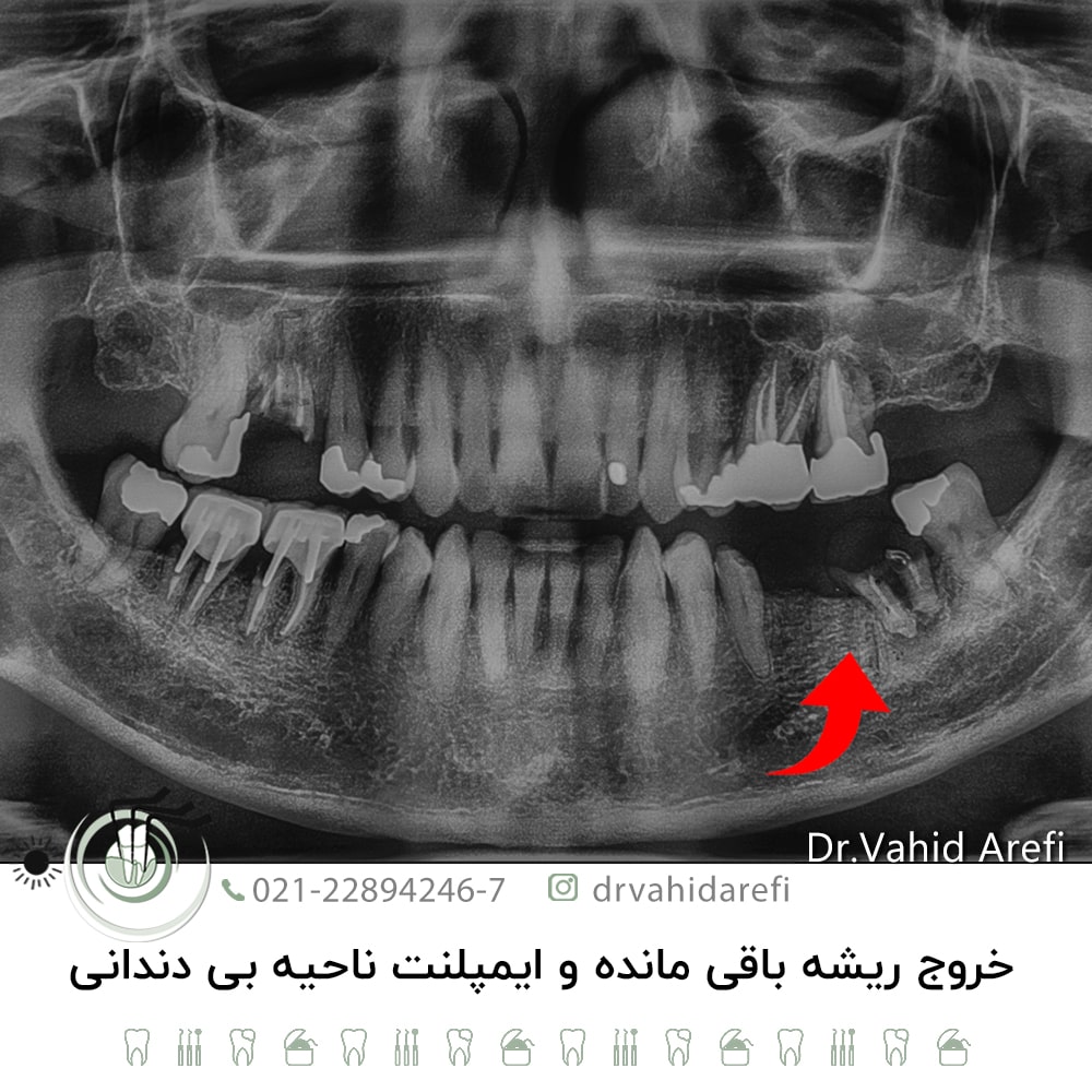 خروج ریشه باقی‌مانده و ایمپلنت ناحیه بی‌ دندانی