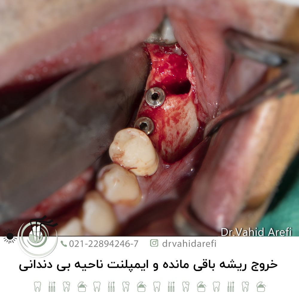 خروج ریشه باقی‌مانده و ایمپلنت ناحیه بی‌ دندانی