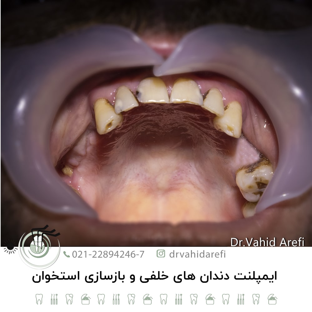 ایمپلنت دندان‌های خلفی و بازسازی استخوان