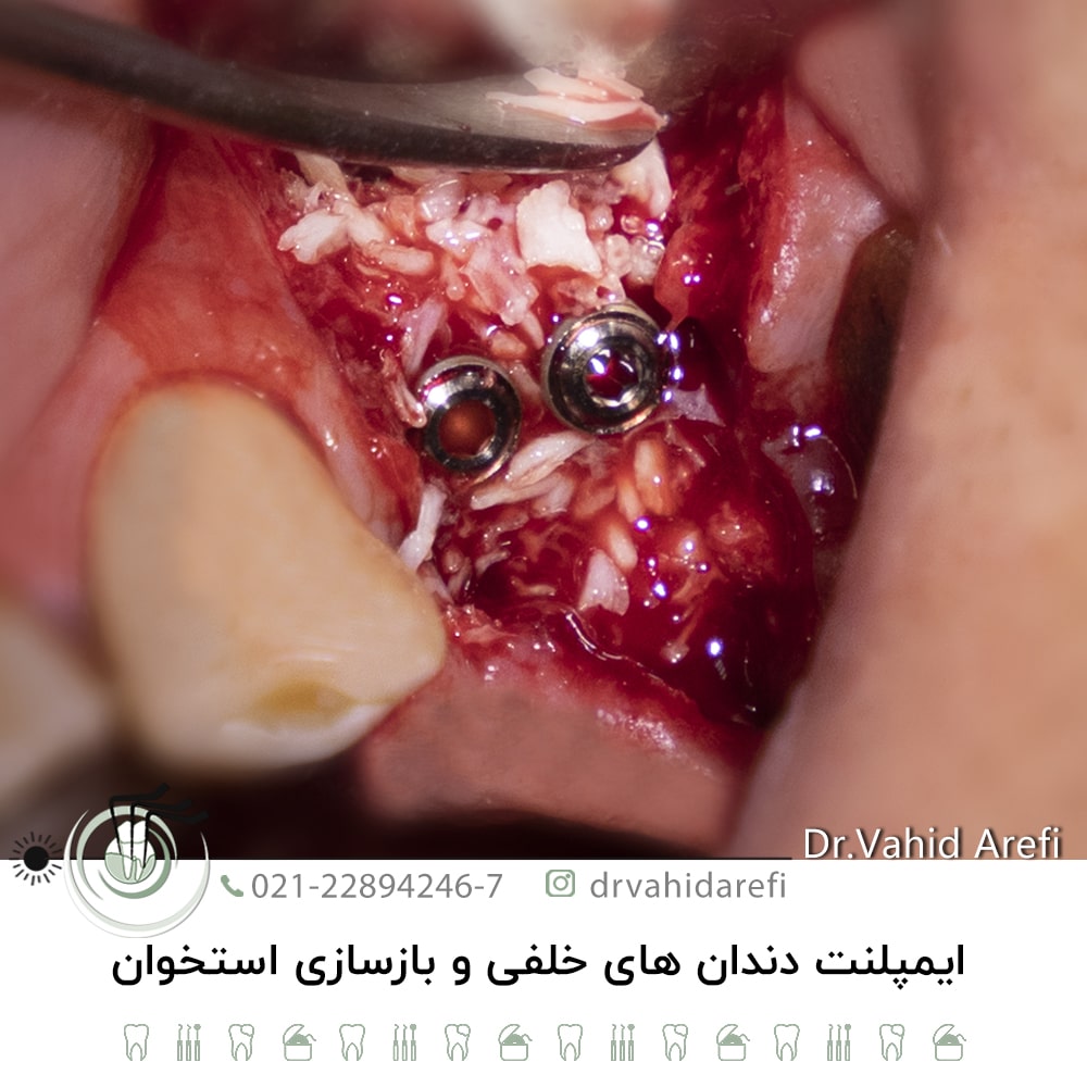 ایمپلنت دندان‌های خلفی و بازسازی استخوان