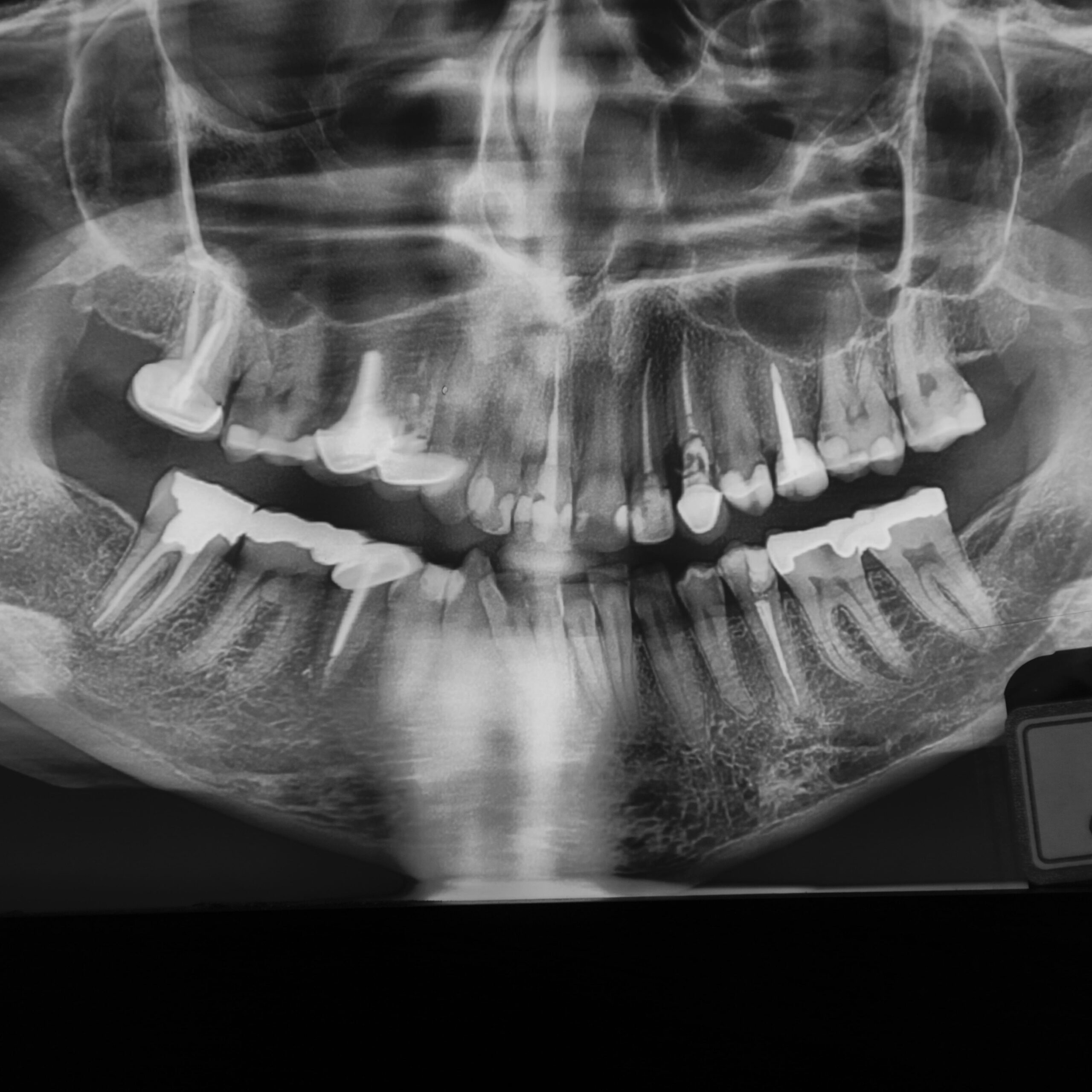 خارج کردن دندان و بازسازی استخوان