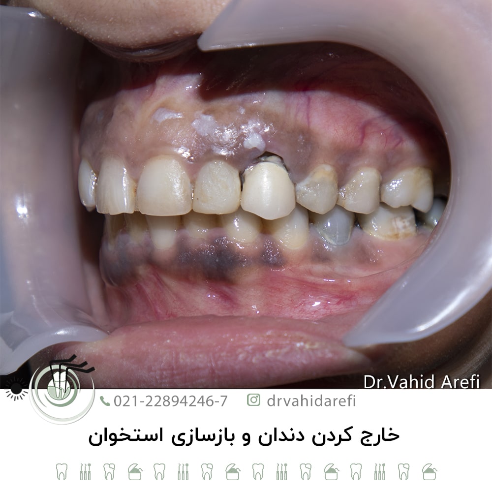 خارج کردن دندان و بازسازی استخوان