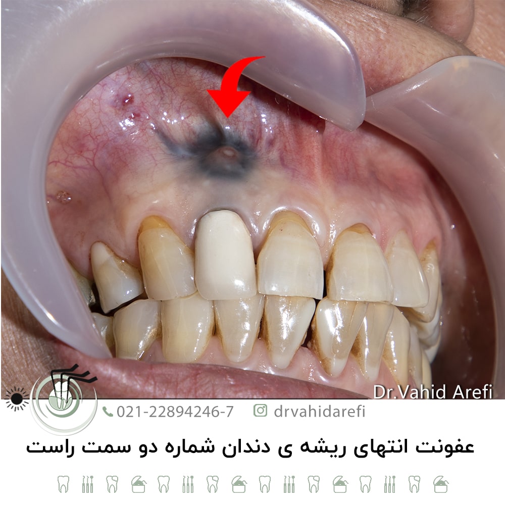 عفونت انتهای ریشه دندان شماره دو سمت راست