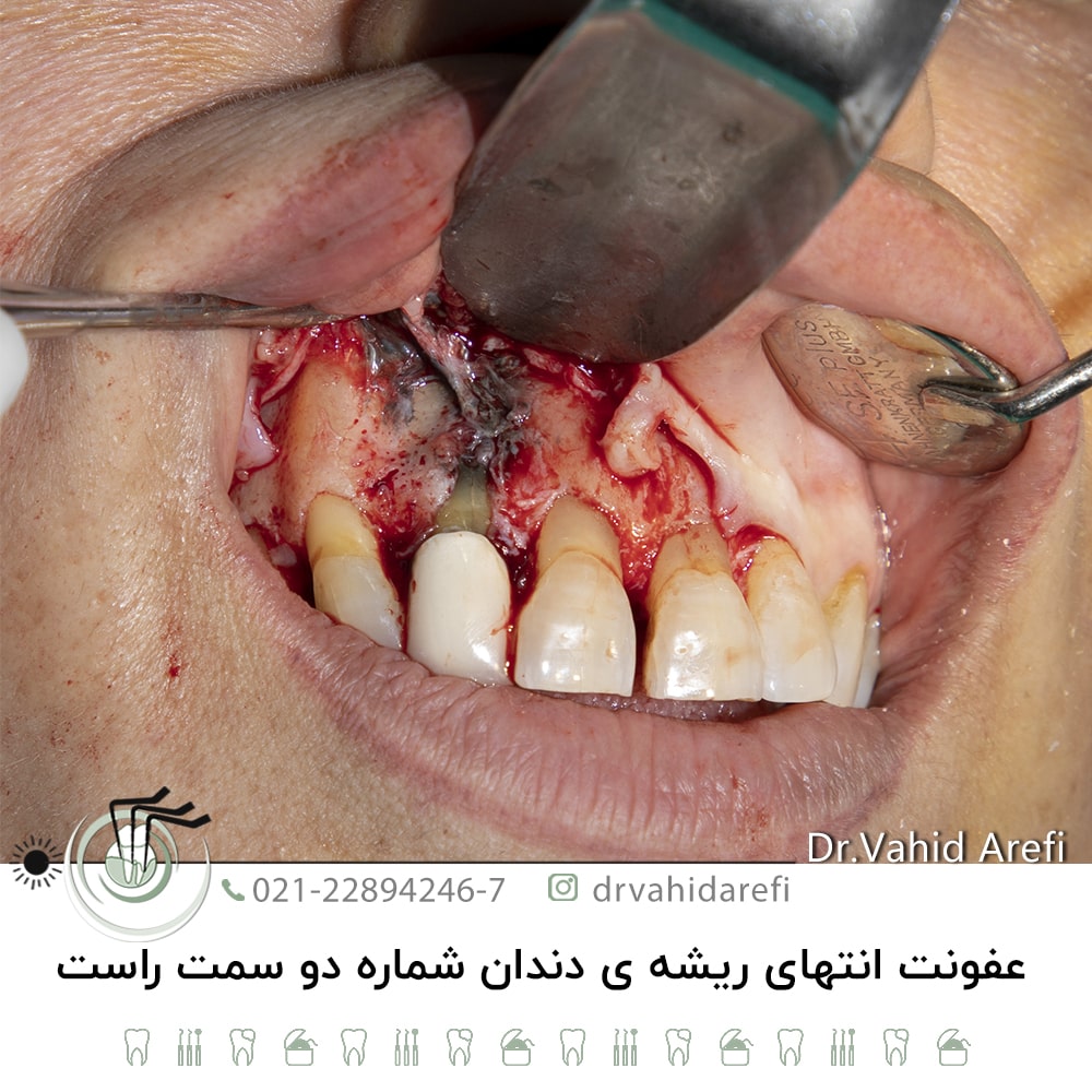عفونت انتهای ریشه دندان شماره دو سمت راست