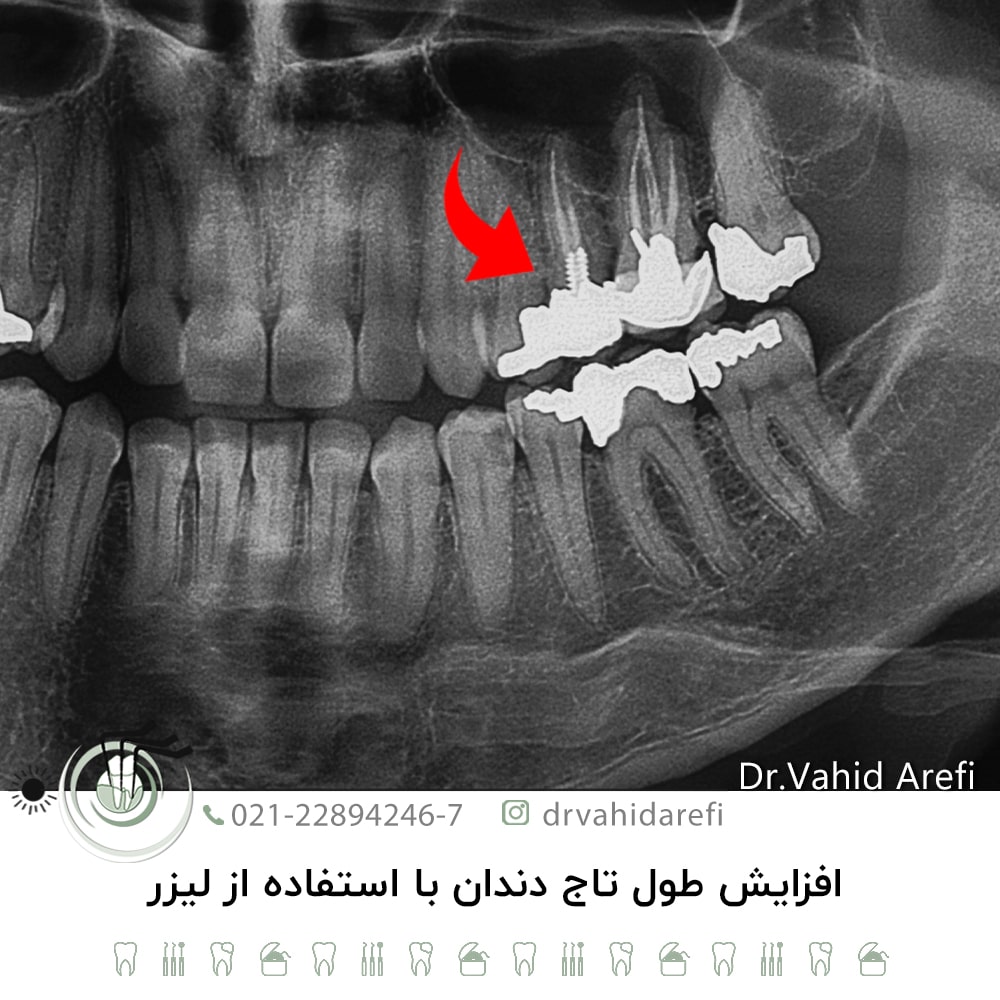 افزایش طول تاج دندان با استفاده از لیزر