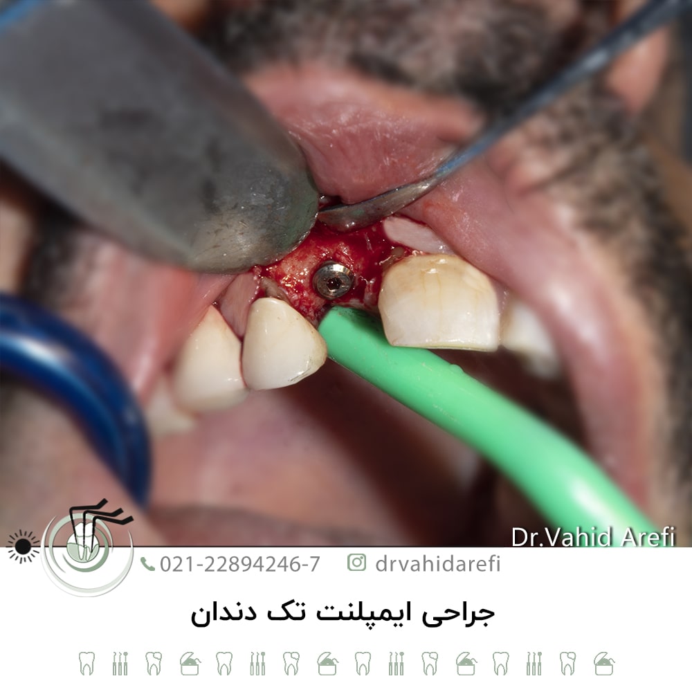 جراحی ایمپلنت تک دندان