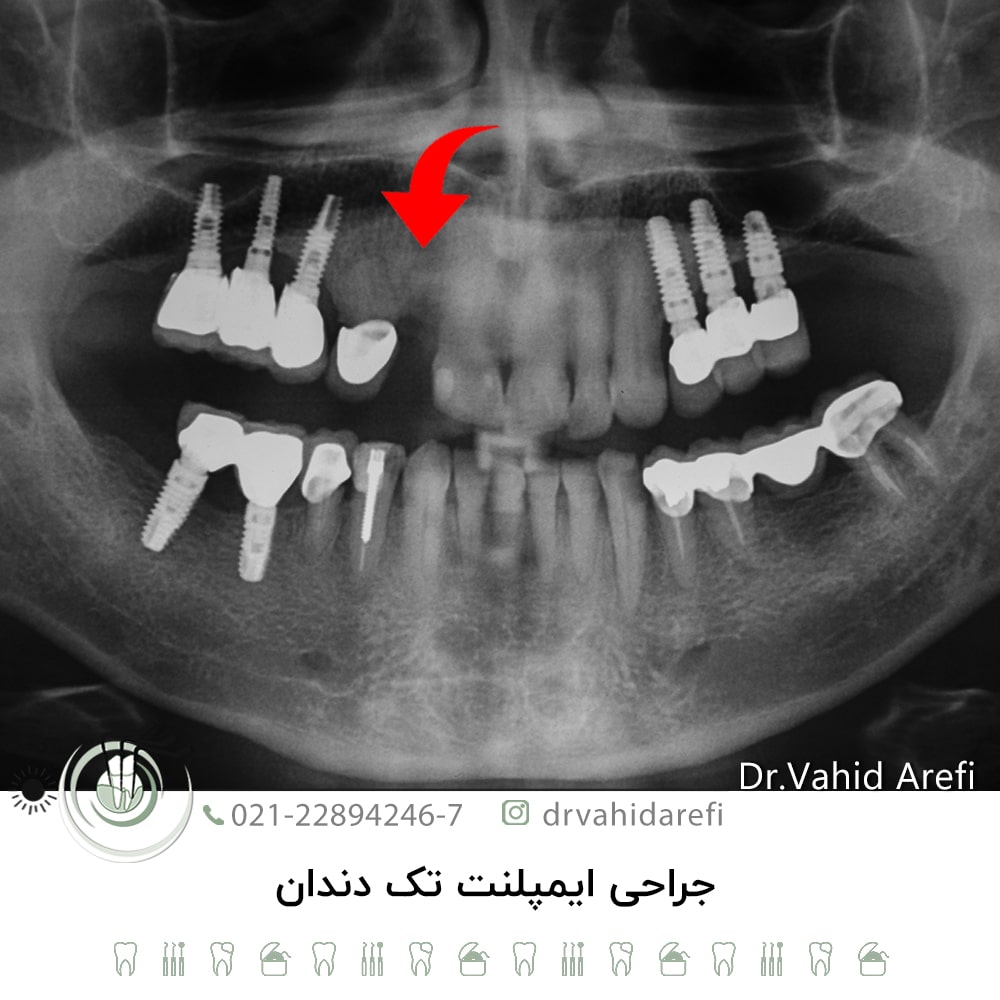 جراحی ایمپلنت تک دندان