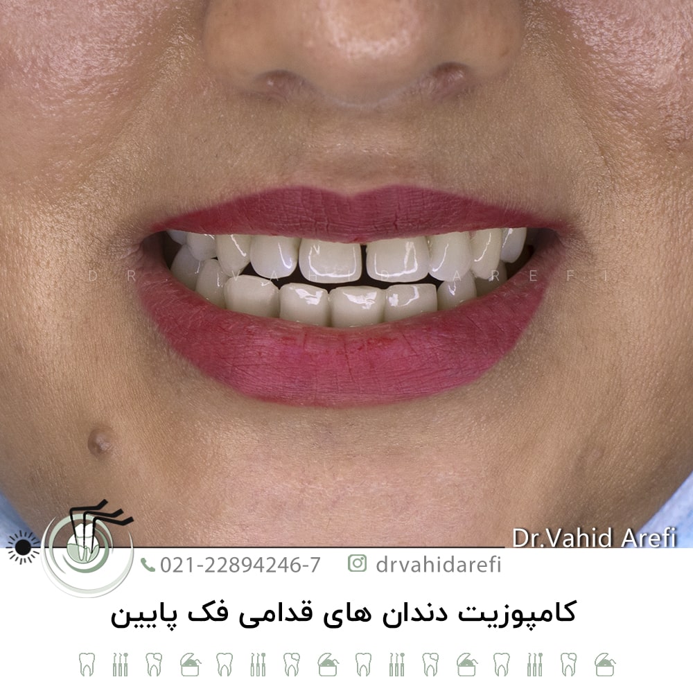 کامپوزیت دندان‌های قدامی فک پائین