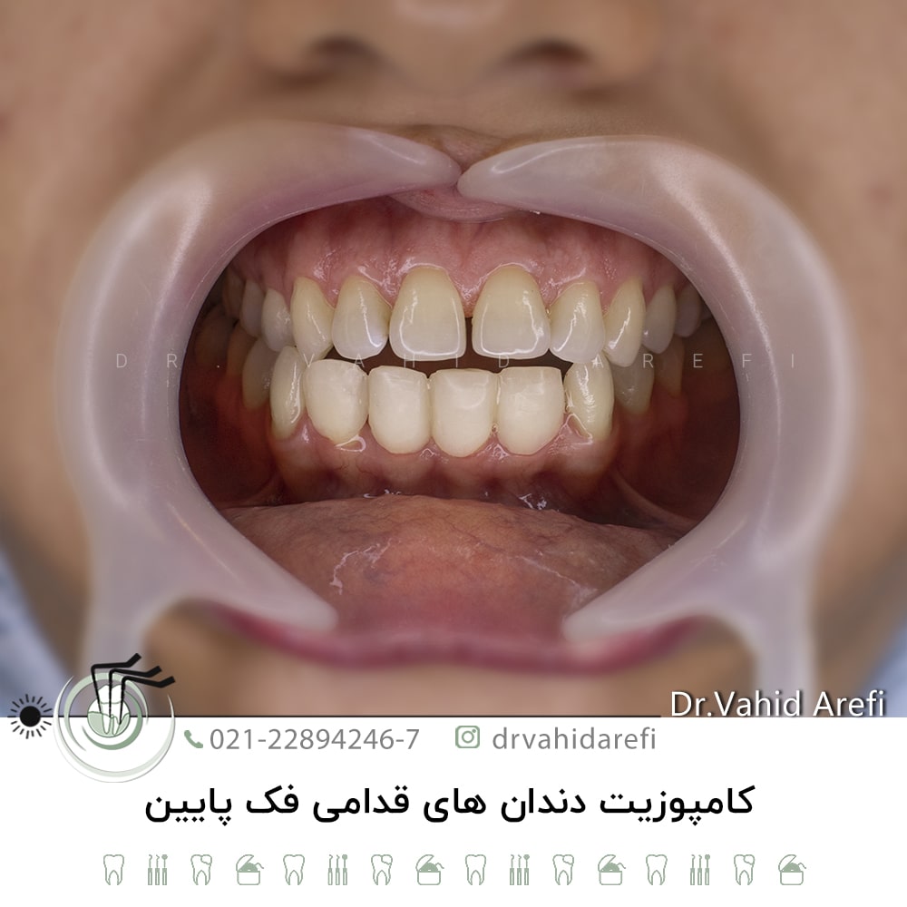 کامپوزیت دندان‌های قدامی فک پائین