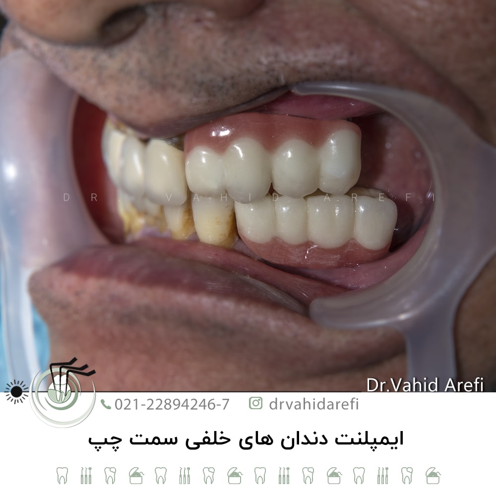 ایمپلنت دندان‌های خلفی سمت چپ