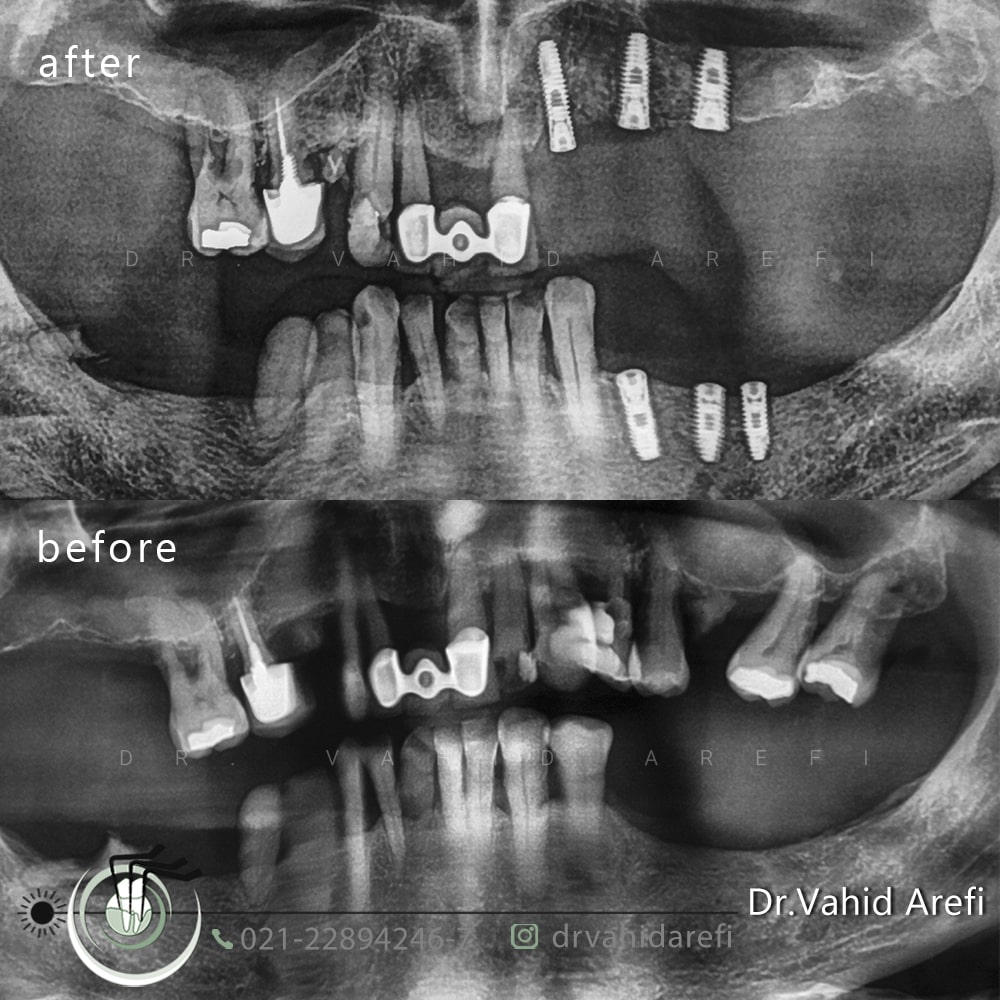 ایمپلنت دندان‌های خلفی سمت چپ