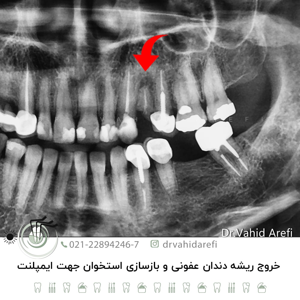 خروج ریشه دندان عفونی و بازسازی استخوان جهت ایمپلنت