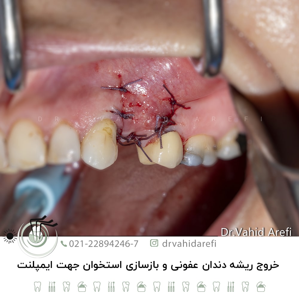 خروج ریشه دندان عفونی و بازسازی استخوان جهت ایمپلنت