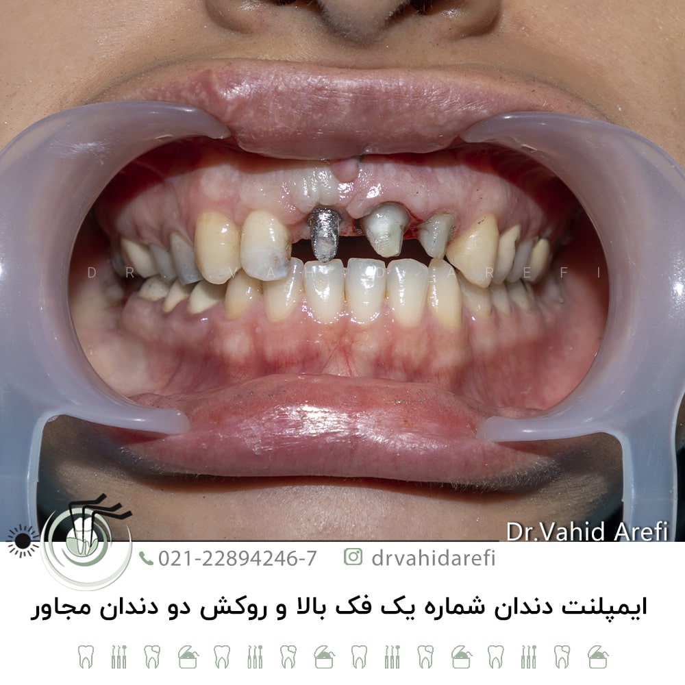 ایمپلنت دندان شماره یک فک بالا و روکش دو دندان مجاور