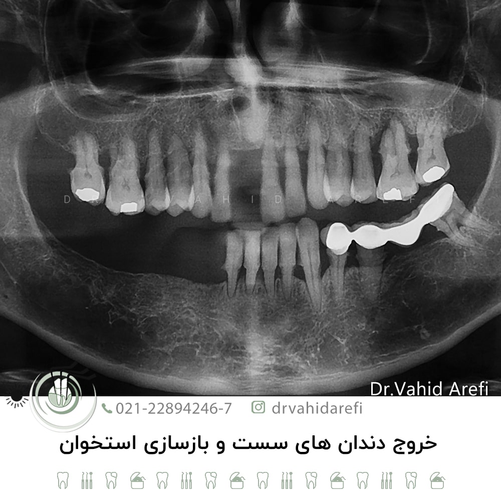 خروج دندان‌های سست و بازسازی استخوان