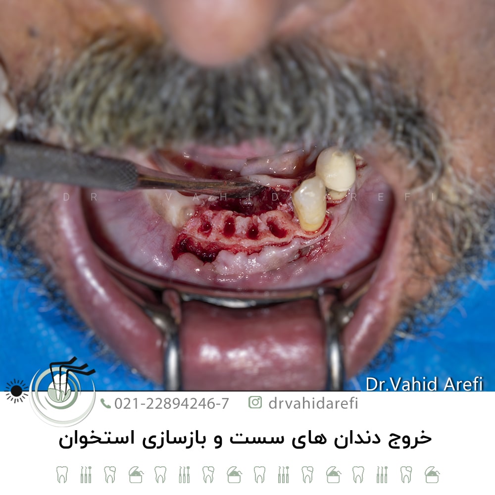 خروج دندان‌های سست و بازسازی استخوان