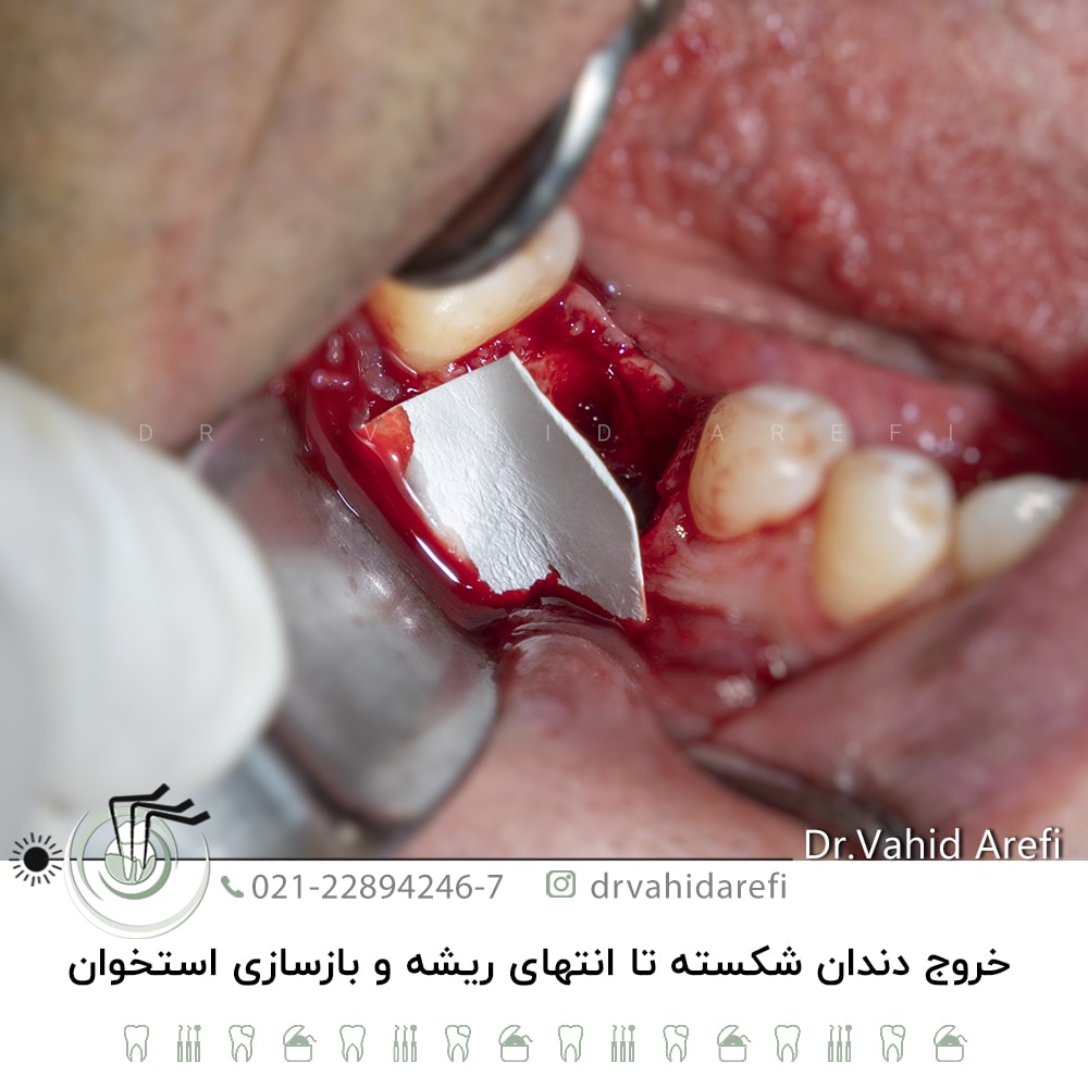 خروج دندان‌ شکسته تا انتهای ریشه و بازسازی استخوان