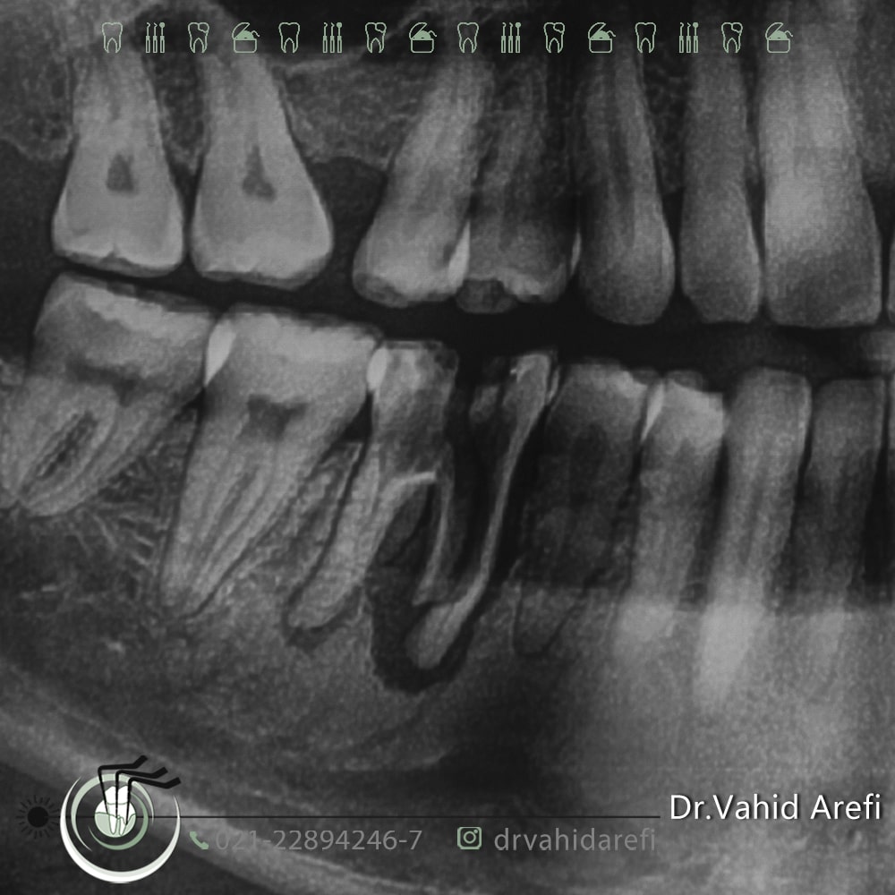 خروج دندان‌ شکسته تا انتهای ریشه و بازسازی استخوان