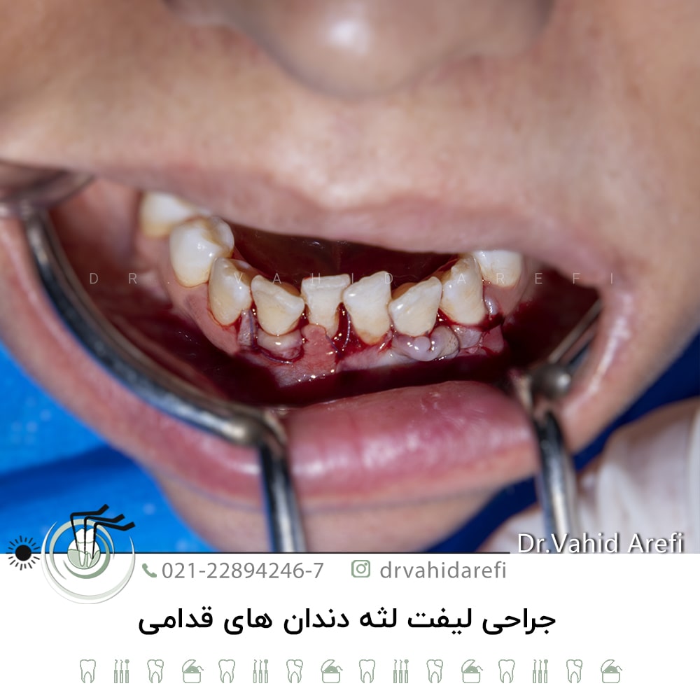 جراحی لیفت لثه دندان‌های قدامی