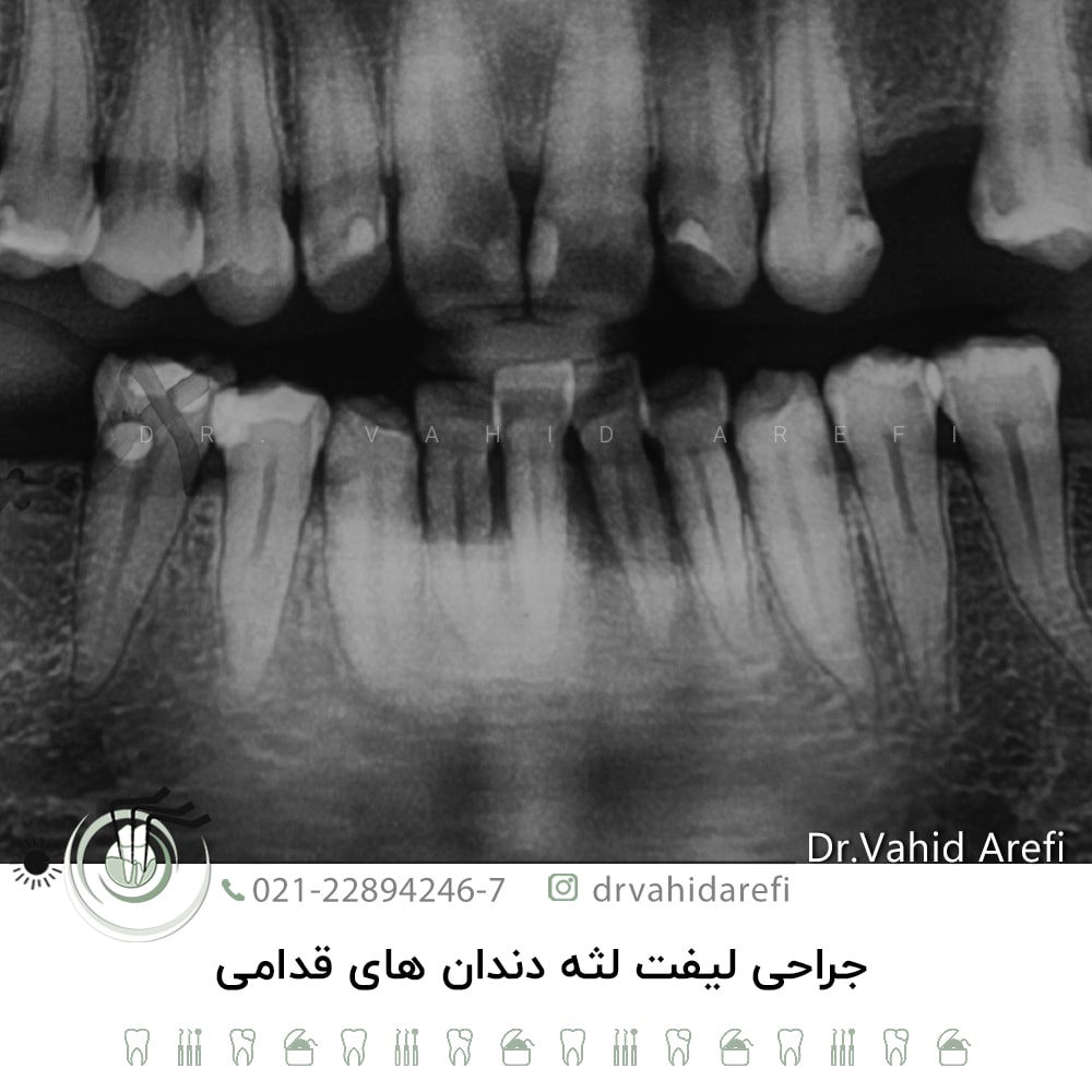 جراحی لیفت لثه دندان‌های قدامی