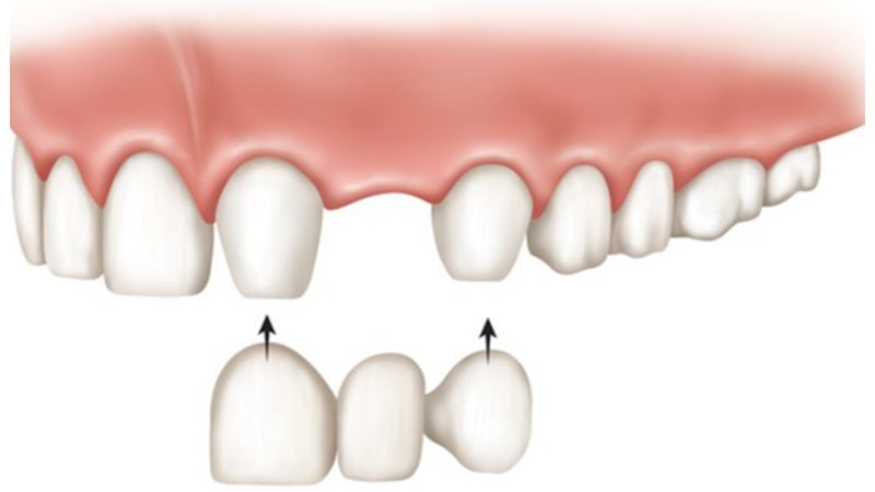 Figure 2 فقدان دندان در قسمت های جلو فک