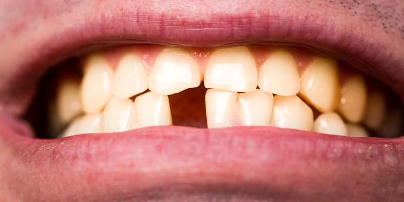 Figure 3 جایگزین کردن دندان های جلویی با استفاده از ایمپلنت