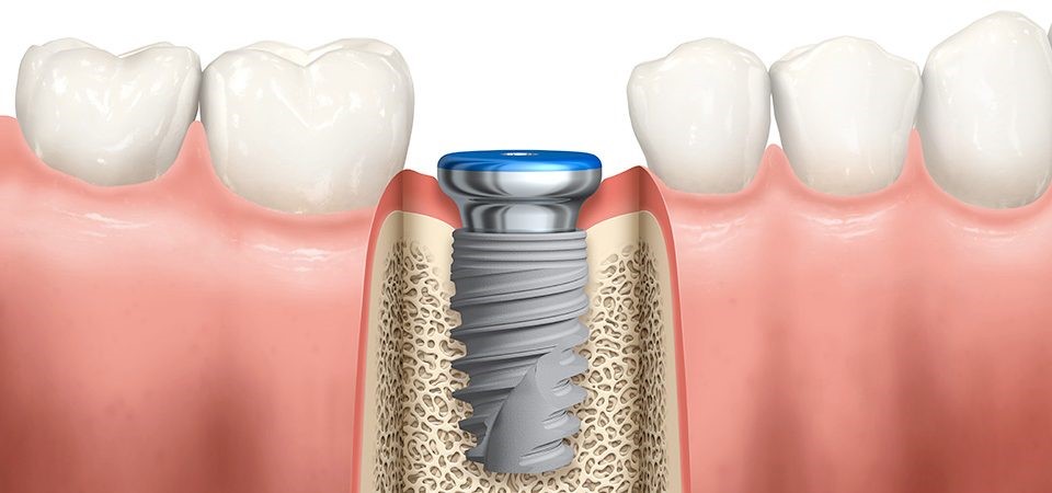ایمپلنت فوری چیست؟