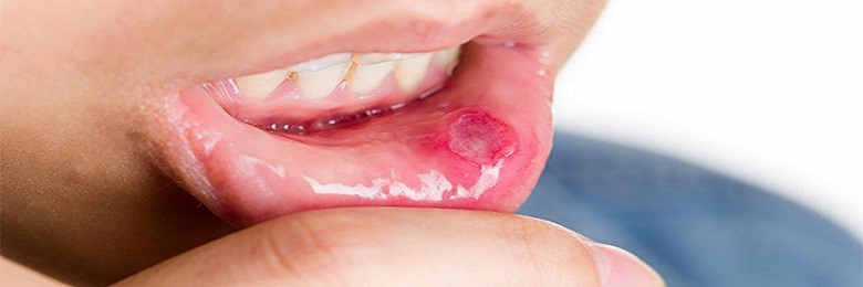 لیزر درمانی آفت دهان