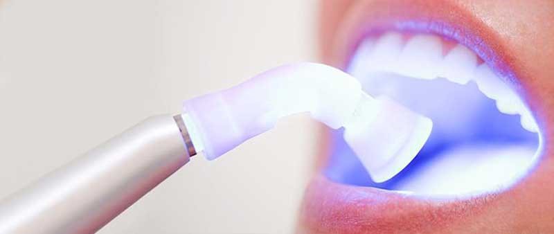مزایای لیزر دندان