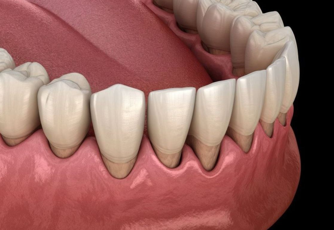 Figure 1 تحلیل رفتن لثه ها و نمایان شدن ریشه دندان