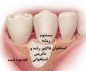Figure 1 جراحی بازسازی لثه
