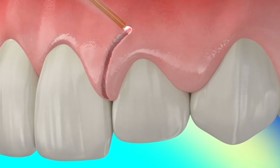 Figure 1 جراحی لثه