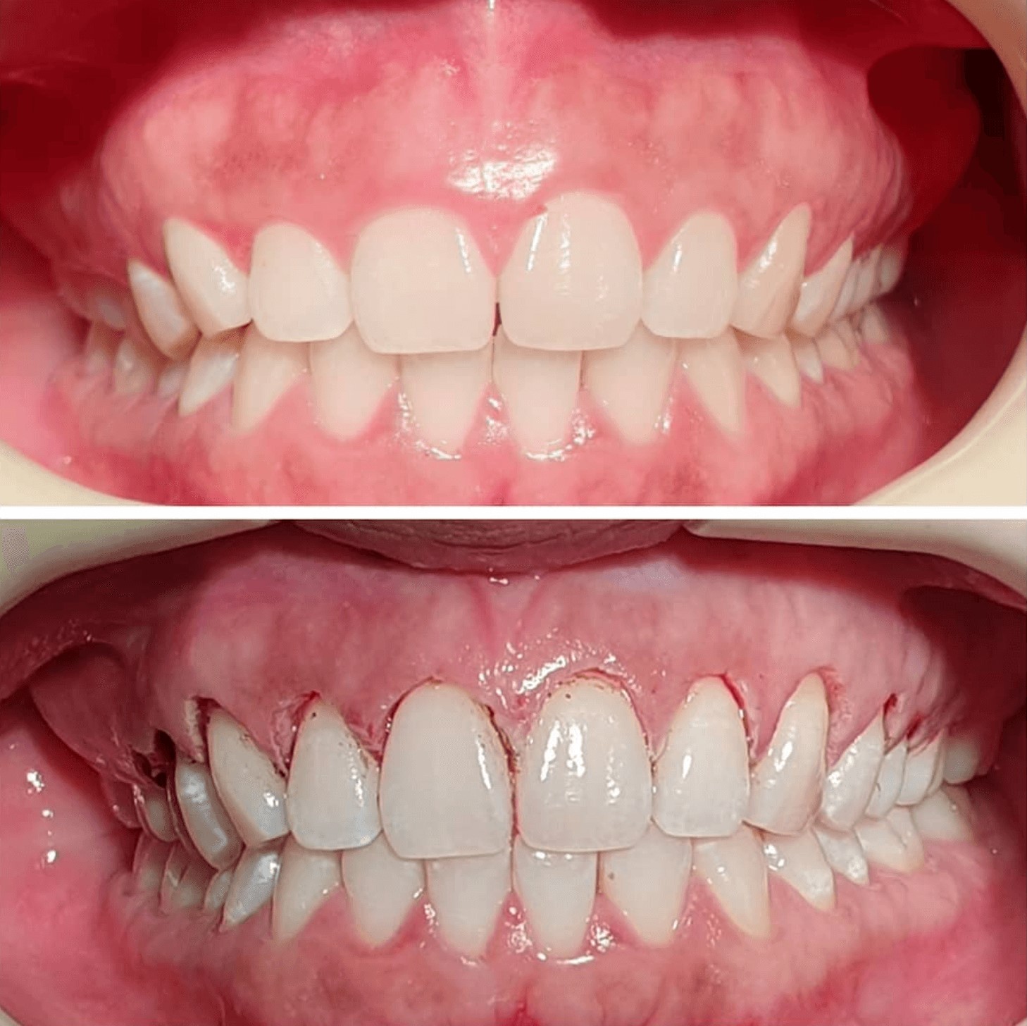 Figure 2 افزایش طول تاج دندان