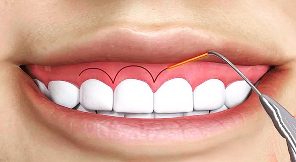 Figure 3 افزایش تاج دندان با استفاده از لیزر