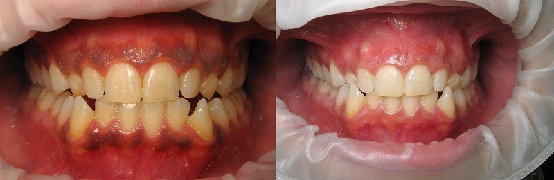 Figure 3 التهاب لثه