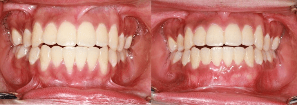 Figure 3 پیوند بافت نرم