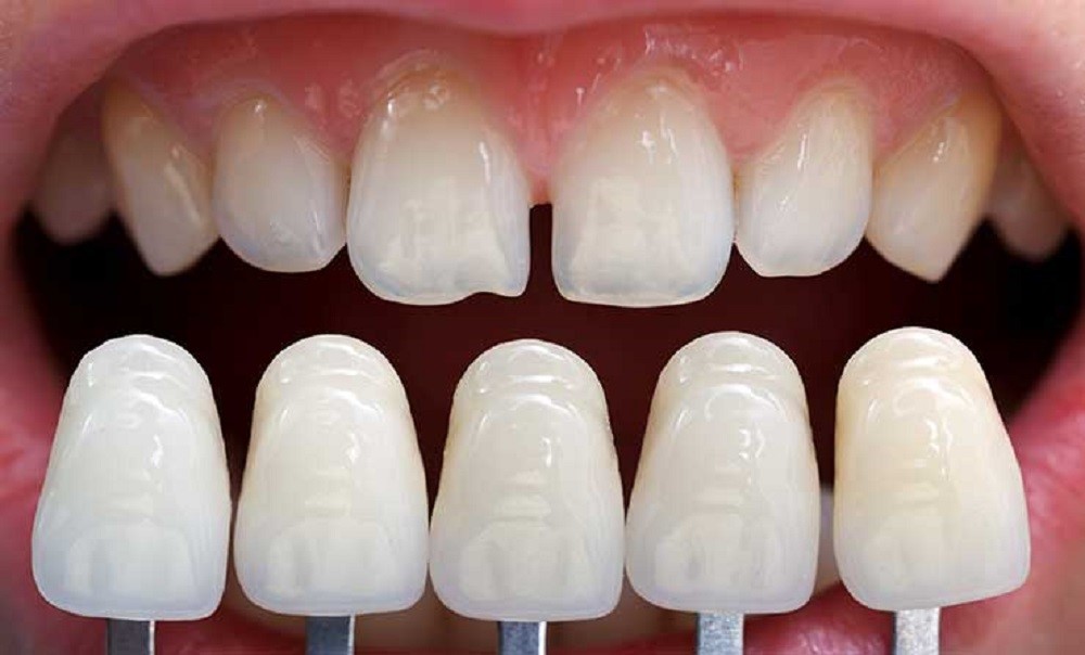 مراحل مختلف لمینت دندان