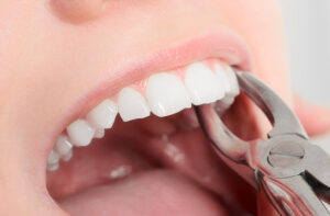 آشنایی با دلایل و مراحل کشیدن دندان