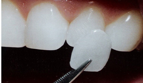 لومینیزر دندان