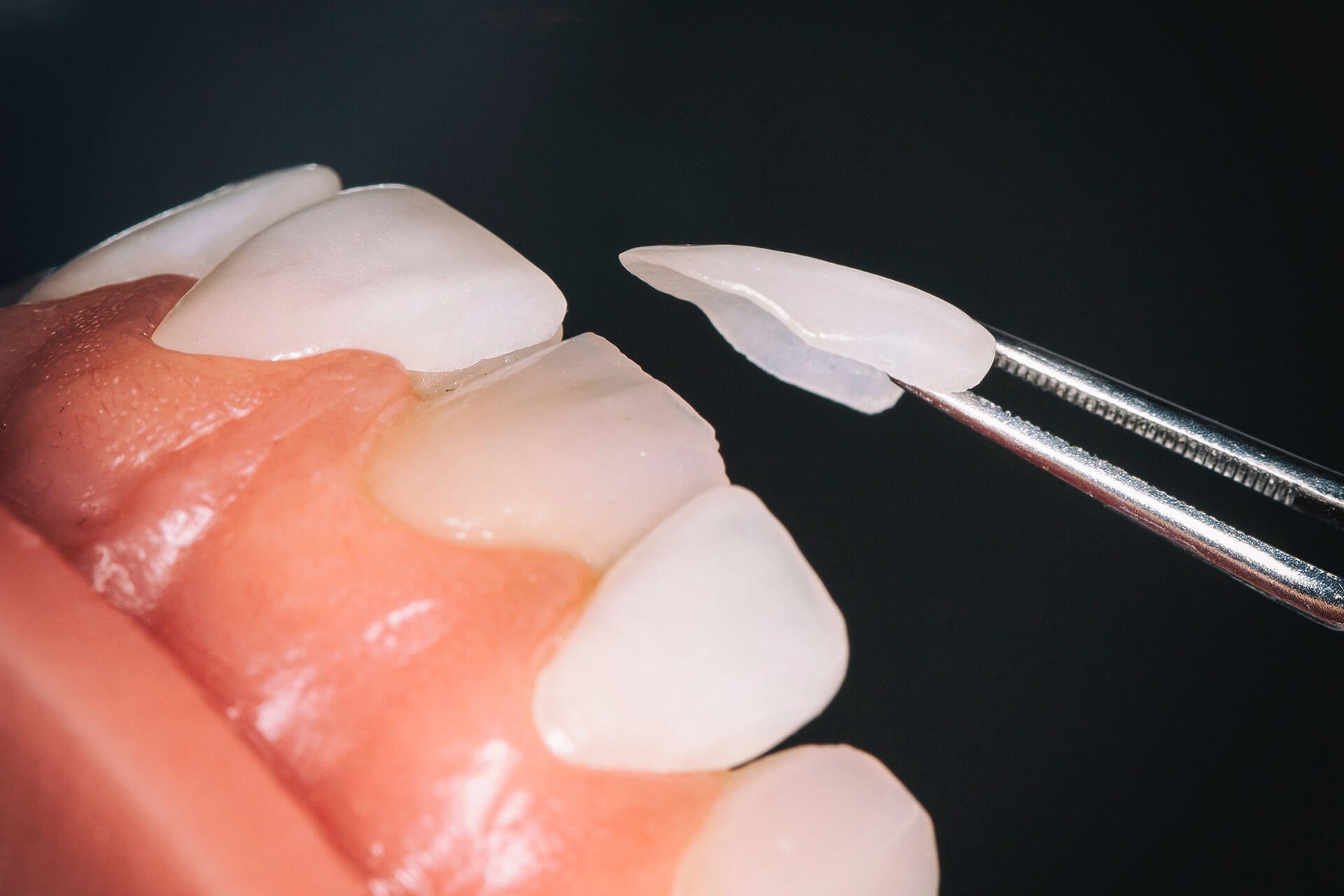 مزایای لومینیزر دندان