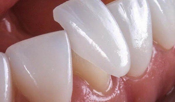 معایب لومینیزر دندان