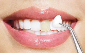 لومینیزر دندان چیست؟