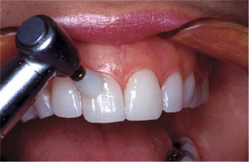 عوارض یا خطرات لمینت دندان چیست؟
