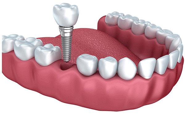 ایمپلنت‌های دندانی از تحلیل استخوان جلوگیری می‌کنند