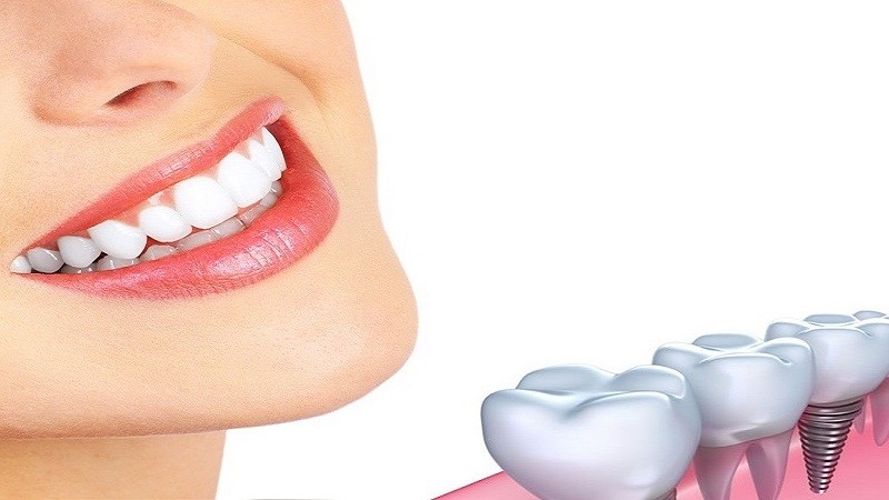 ایمپلنت معمولی چیست؟