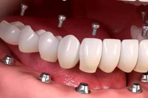 چه کسانی می‌توانند ایمپلنت فوری دندان انجام دهند.