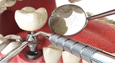 مراحل ایمپلنت فوری دندان
