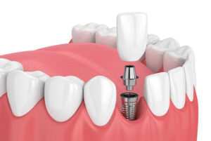 آیا دندان ایمپلنت خراب می شود ؟