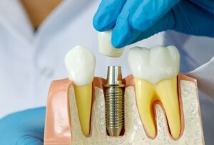 کدام نوع درمان برای افراد بهتر است ایمپلنت دندان معمولی یا فوری