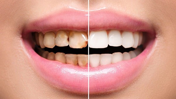 چگونه برای هر مورد بالینی مناسب ترین کامپوزیت دندان را انتخاب کنیم؟